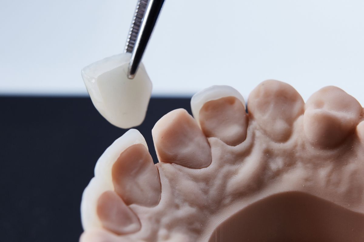 Featured image for “Essential Tips for Maintaining and Caring for Dental Crowns”