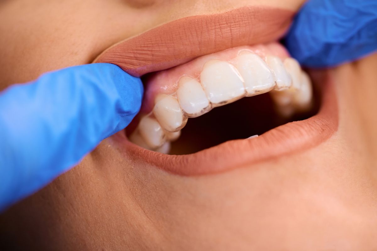 Featured image for “How Invisalign Can Improve More Than Just Your Smile”